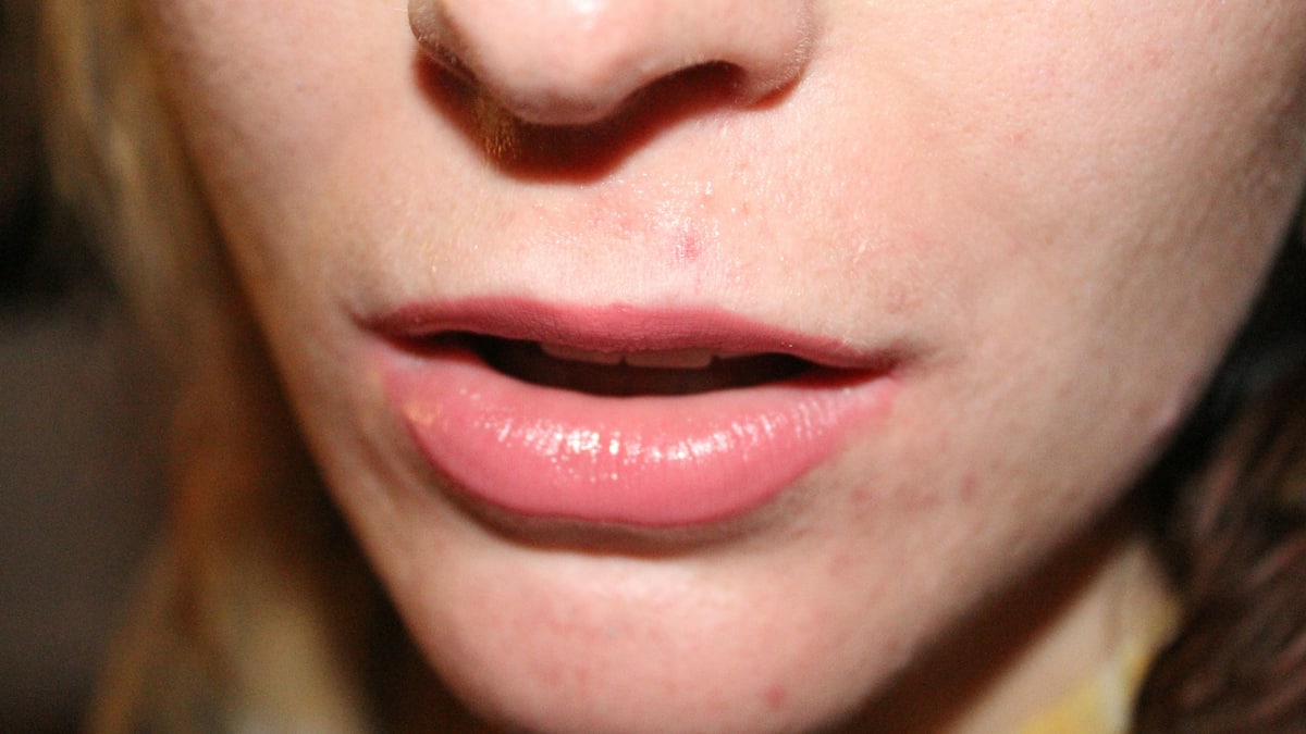 Welche-Ursachen-haben-Pickel-