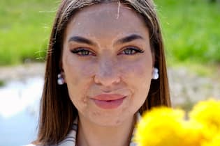 Mafalda möchte trotz ihrer Narben Model werden Mafalda Da Silva