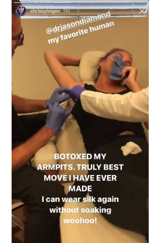 Chrissy Teigen spritzt sich Botox in die Achseln.