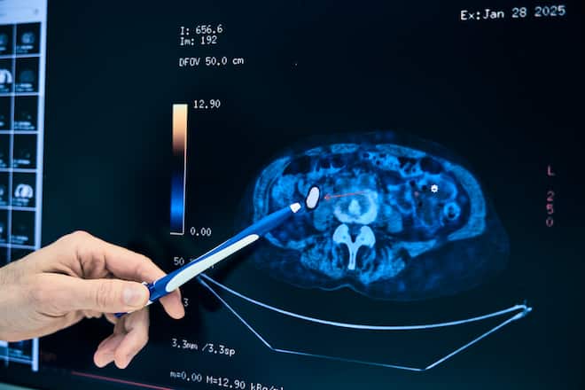 Interview Darmkrebs Hirslanden