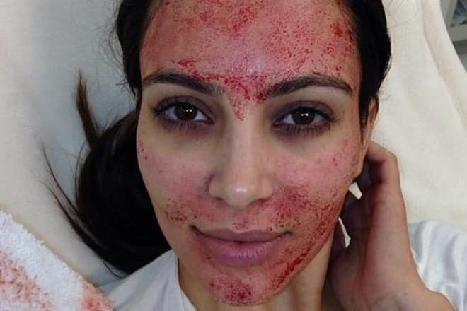 kim kardashian vampire facial