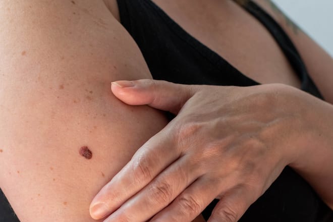 Wer viele Pigmentmale auf der Haut hat, sollte diese regelmässig untersuchen.
