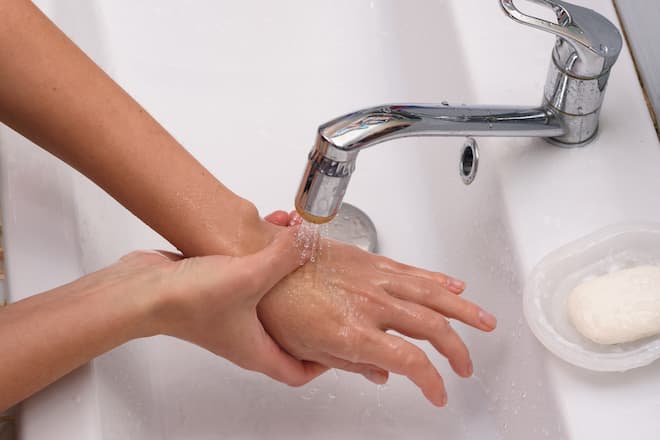 Bei leichten Verbrennungen kann Kühlen Linderung verschaffen.