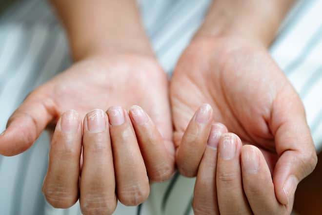 Brüchige Nägel haben meist einen Grund.